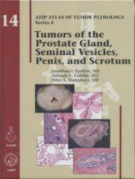 tumors-of-the-prostate-gland-