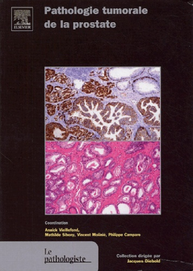 Pathologie tumorale de la prostate