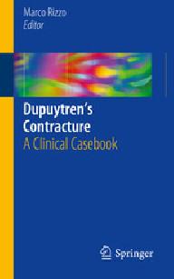 Dupuytrens contracture
