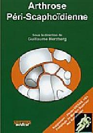 ARTHROSE PERI SCAPHOIDIENNE
