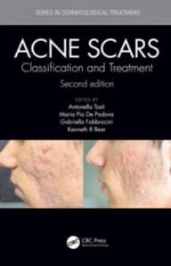 ACNE SCARS : CLASSIFICATION...