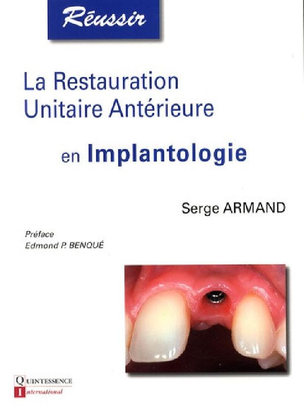 La restauration Unitaire Ant?rieure en Implantologie
