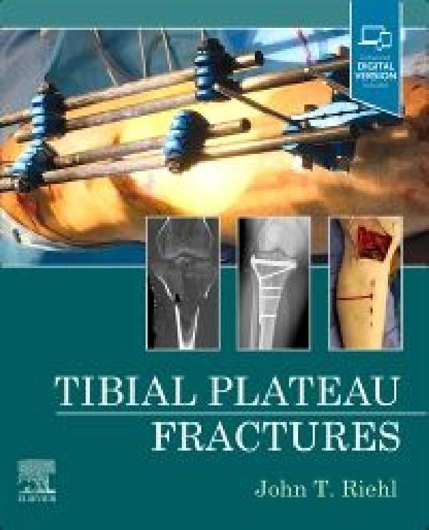 TIBIAL PLATEAU FRACTURES