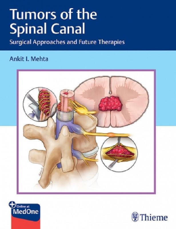 TUMORS OF THE SPINAL CANAL