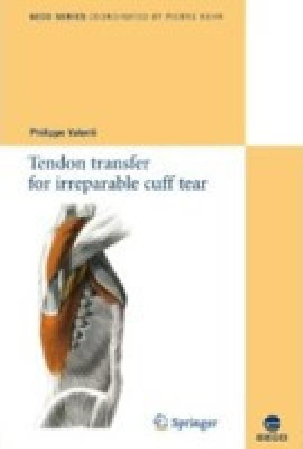 TENDON TRANSFER FOR IRREPARABLE CUFF TEAR