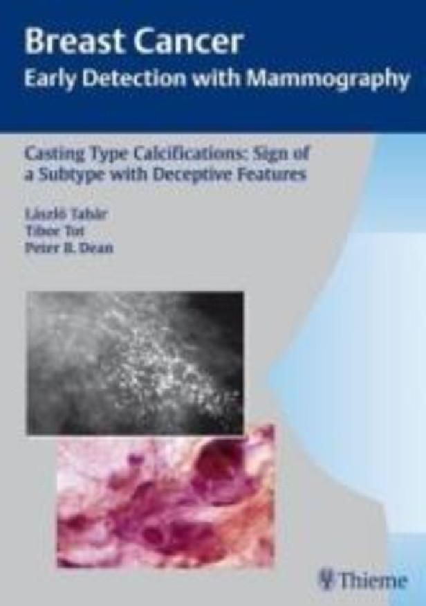 CASTING-TYPE CALCIFICATIONS: SIGN OF A SUBTYPE WITH DECEPTIVE FEATURES