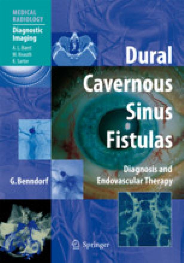 DURAL CAVERNOUS SINUS FISTULAS