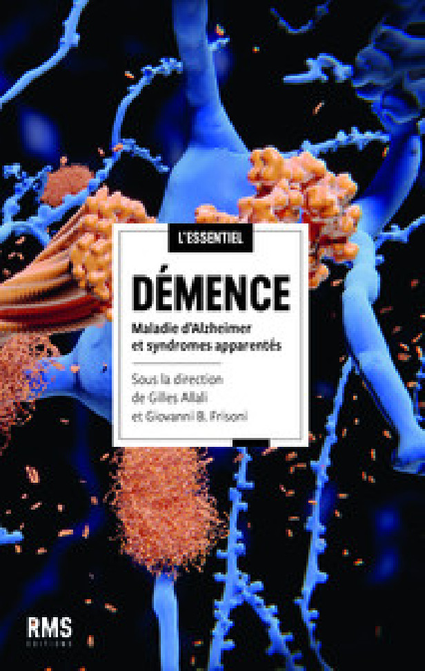 DEMENCE : MALADIE D'ALZHEIMER ET SYNDROMES APPARENTES.