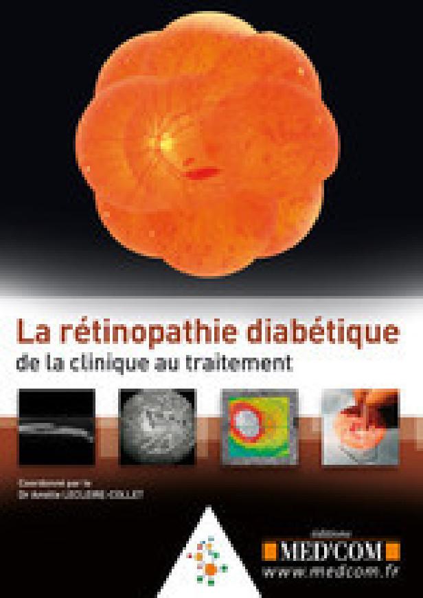 LA RETINOPATHIE DIABETIQUE :DE LA CLINIQUE AUTRAITEMENT